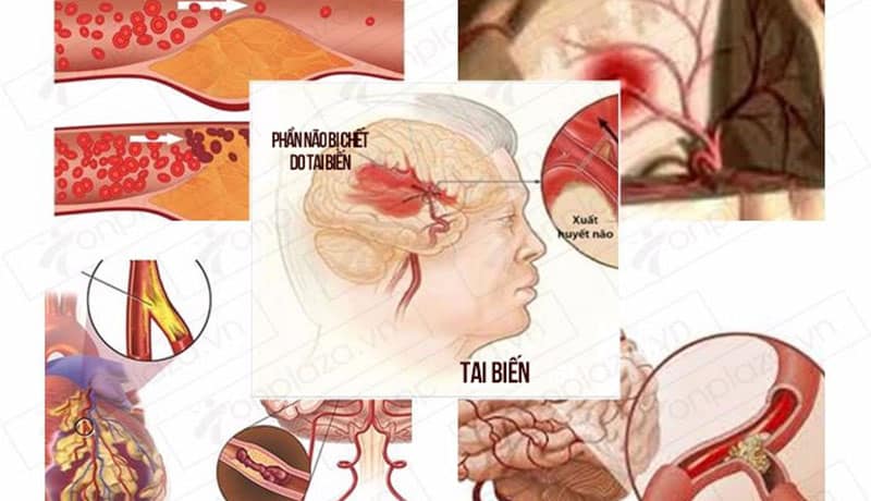 Cách nhận biết bệnh tai biến mạch máu não
